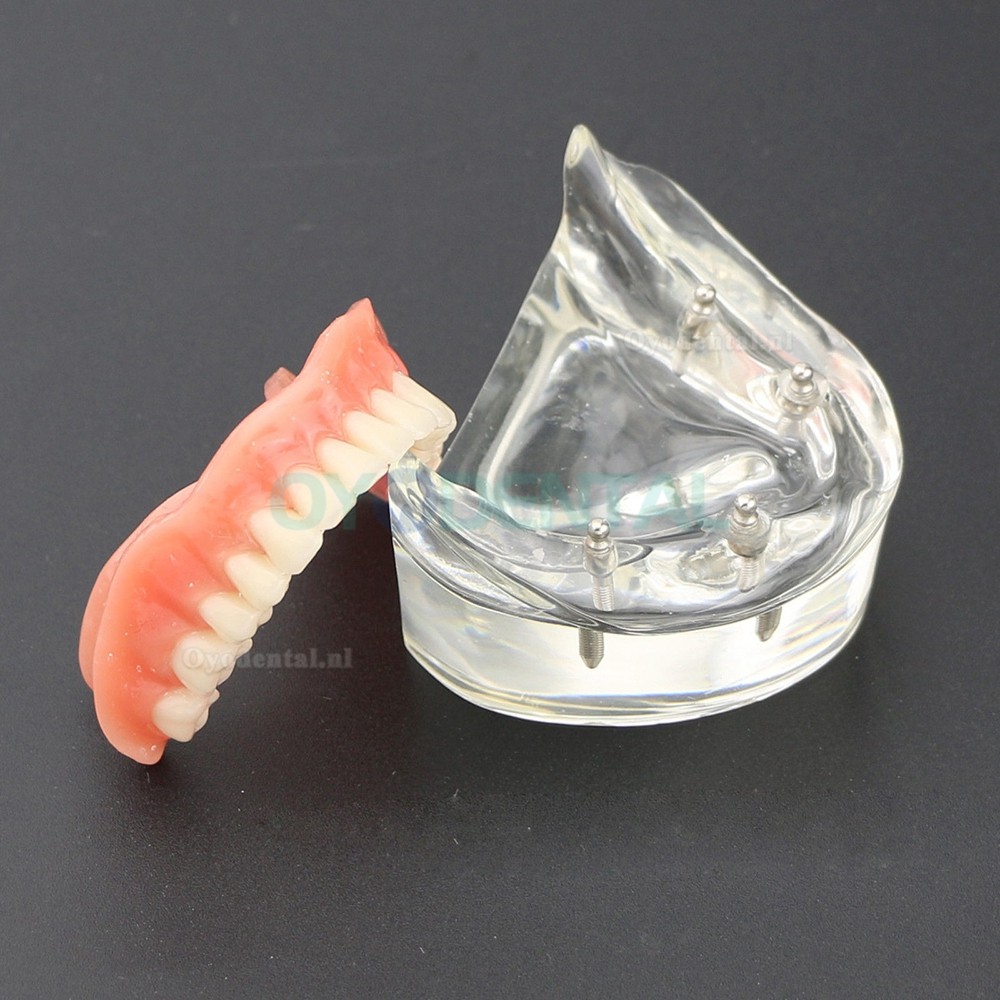 Demo-onderzoek tandheelkundige onderste tanden Model 6002 02 Overdenture Inferior 4 implantaten